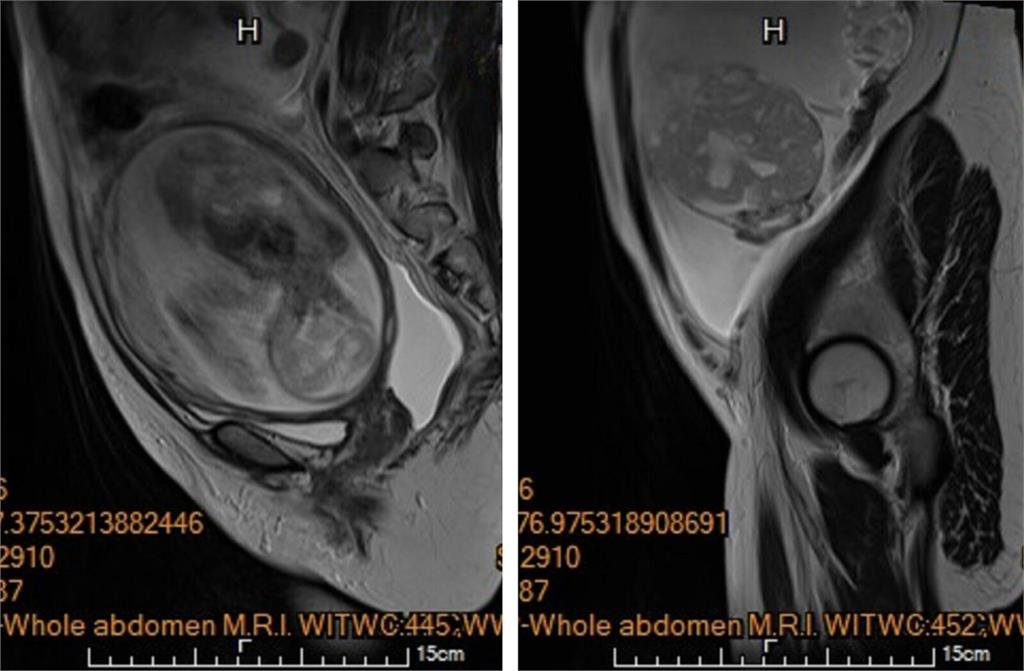 懷孕5月驚見「孩子身旁長出大腫瘤」!  馬偕醫巧手拆彈保住胎兒