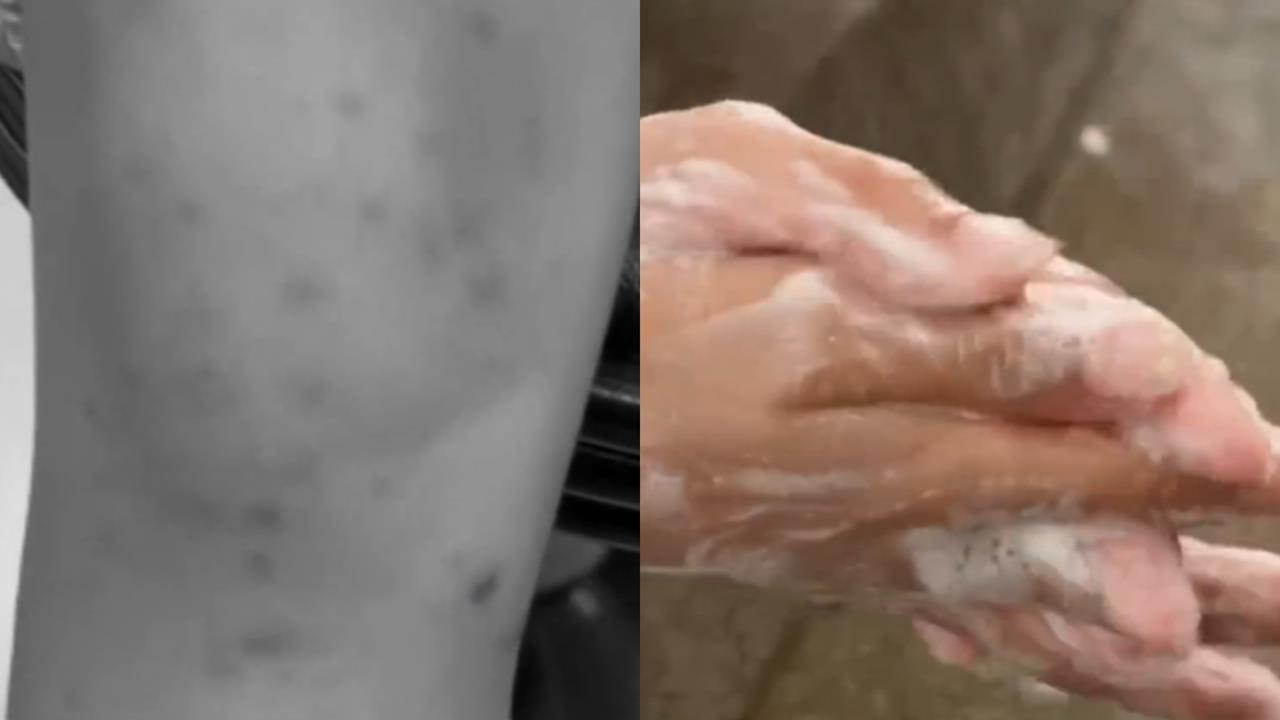 高雄小學驚傳「腸病毒群聚」15童染疫！「醫護夫妻」隱瞞病情挨罰12萬