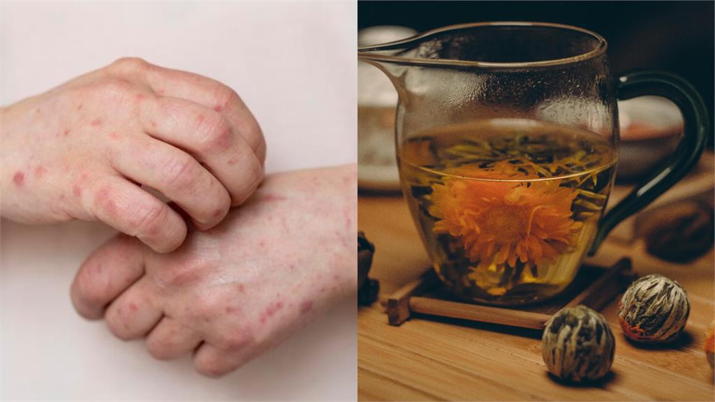 麻疹狂燒接觸者破3千！中醫籲「盡速接種疫苗」曝「6類食物」預防大於治療