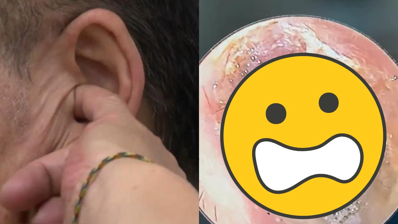 耳朵癢有人想？外籍男就診一照「滿滿菌絲」　醫見1幕驚呆：已自成生態系