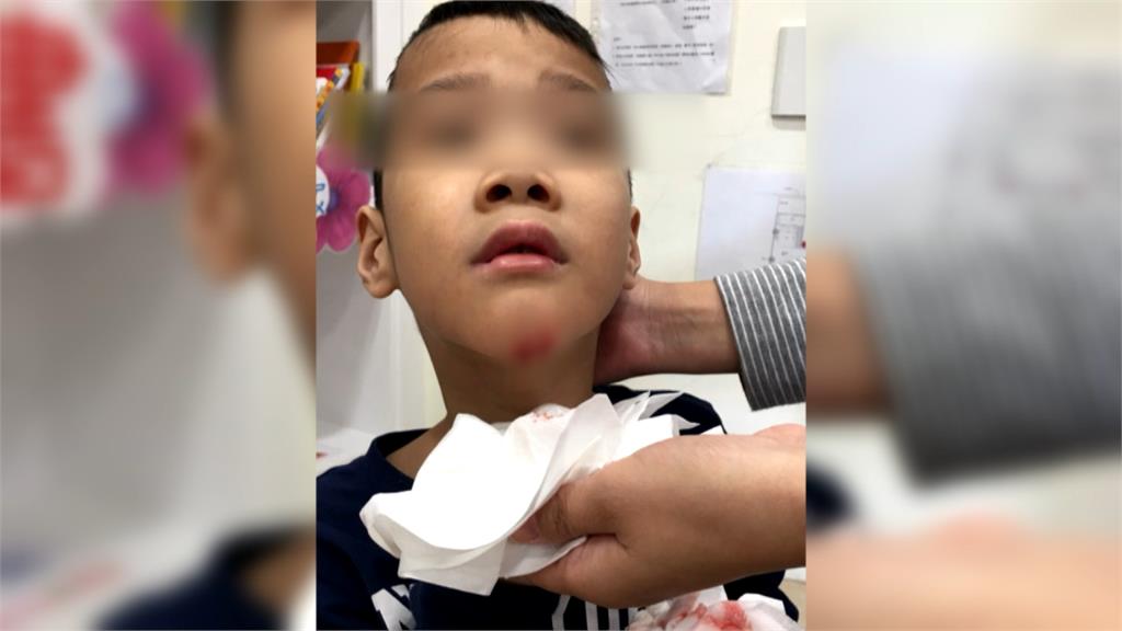 男童幼兒園內受傷下巴縫7針 影片曝光後家長氣炸
