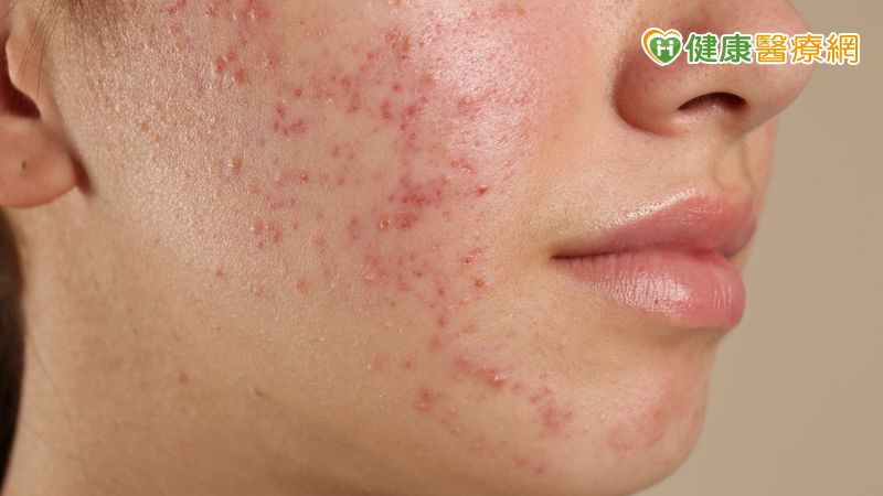 開學遇上滿臉痘痘不敢見同學？醫師教你和孩子如何對抗惱人青春痘