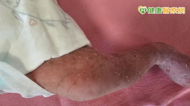 新生女嬰全身長滿小水泡紅疹　竟是罕病「色素失調症」