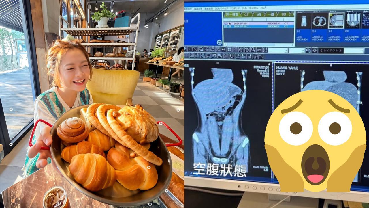 食物到底去哪？大胃王小慧照CT「巨大黑洞現形」 女神嚇傻：魯夫的胃