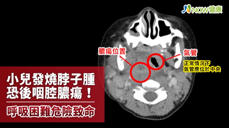 小兒發燒脖子腫恐後咽腔膿瘍 一旦呼吸困難危險致命！