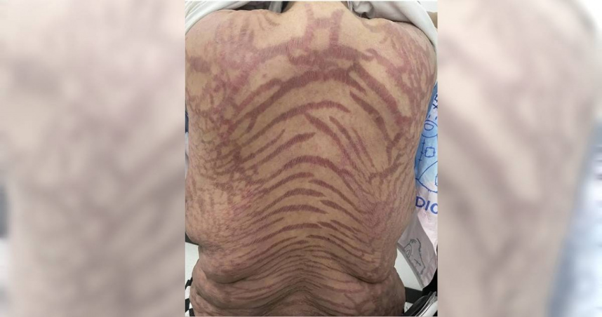 40歲女狂擦「萬能網紅神藥」全身冒紫紅斑紋 醫曝危險成分