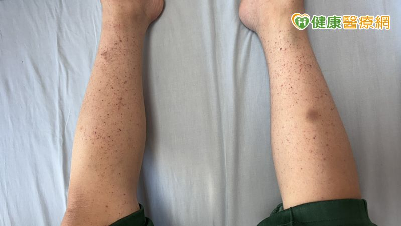 8歲童全身冒小血斑、剔牙大出血　竟是「免疫性紫斑症」險致命