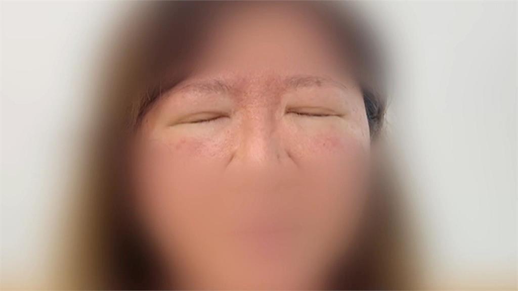 眼皮狂跳如「鬼壓眼」　「眼瞼痙攣」至今找嘸發病原因