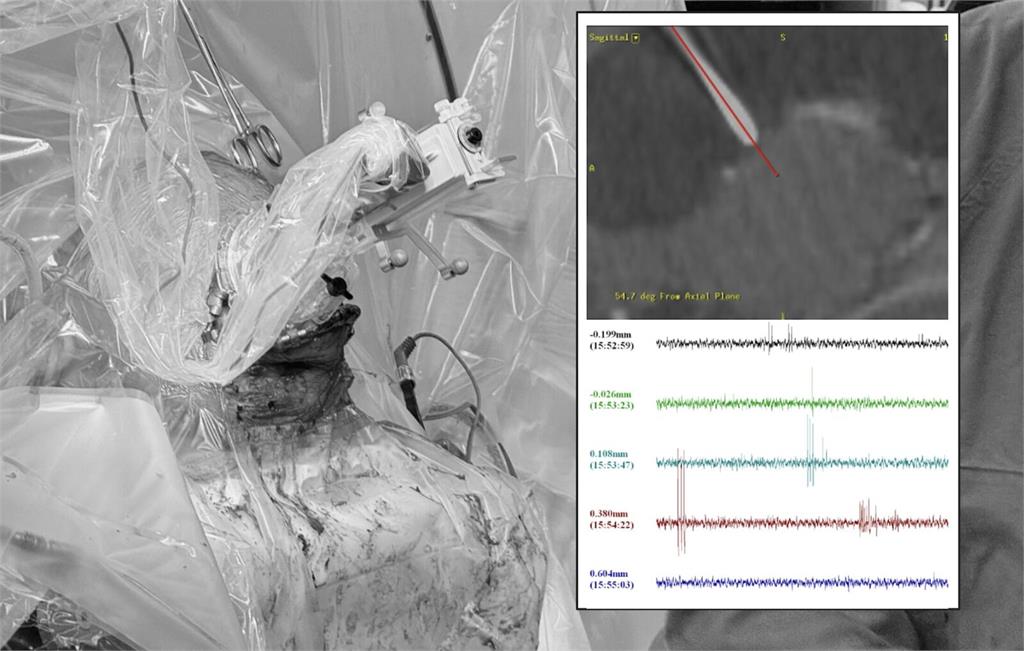 他活到20歲「人生一半時間在癲癇」   台大完成全台首例最新型手術緩解