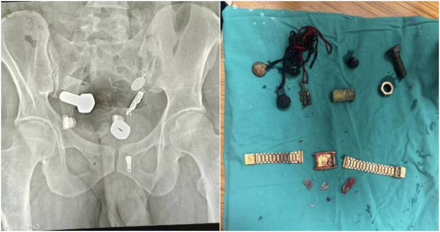 醫護看X光全嚇傻!印度男胃痛就醫 體內驚見手錶、螺絲亂如「開五金行」