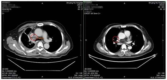 癌末曙光！免疫細胞合併療程抗癌成功　肺腺癌4期癌友喜獲重生