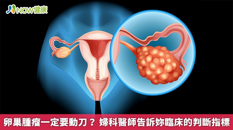 卵巢腫瘤一定要動刀？ 婦科醫師告訴妳臨床的判斷指標