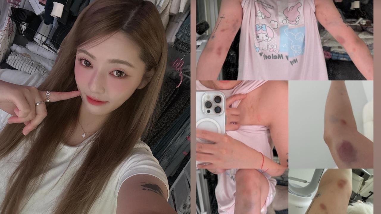 台灣46萬YTR「拒絕陪睡」遭南韓人當街暴打！全身瘀青、骨折傷勢照曝光