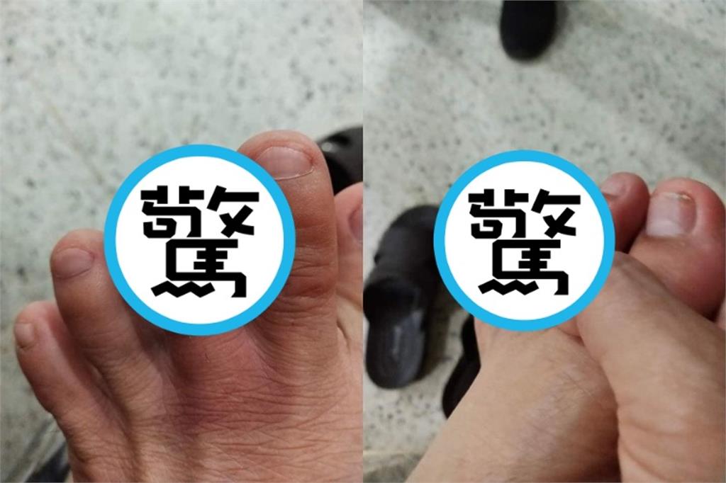 國中生腳趾突變焦黑！竟是「1蟲躲鞋裡灼傷」　醫曝：毒液能噴25公分
