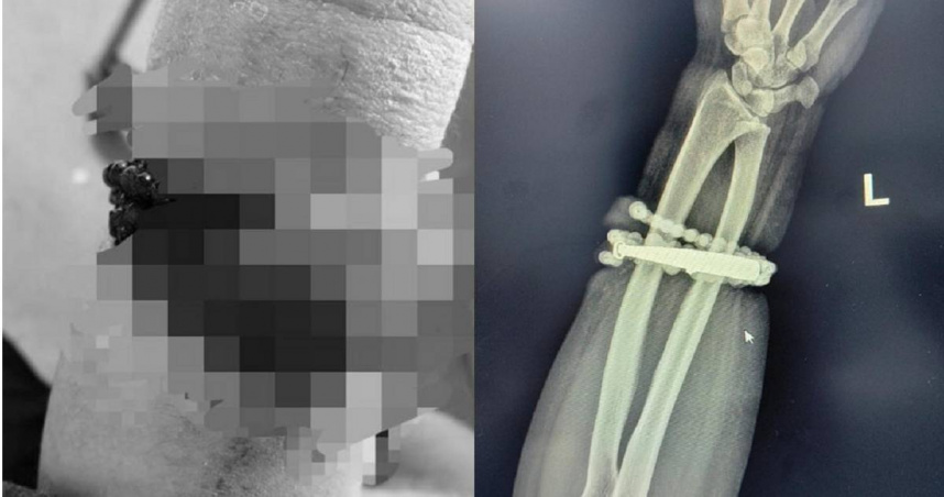 33歲女戴銀手鐲10年未摘「長進肉裡」 醫:恐引發敗血症