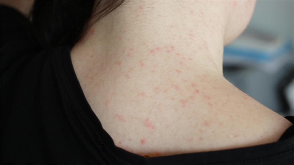 皮膚癢總是好不了？慢性搔癢的３大關鍵 醫：正確照護最重要