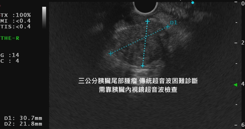 4個月誤診延誤治療!婦人確診胰臟癌 專業醫示警:腰背痛也要警覺