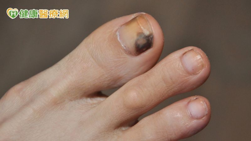 黑痣快速擴大恐是惡性黑色素瘤　醫揭免疫治療機轉與防護重點