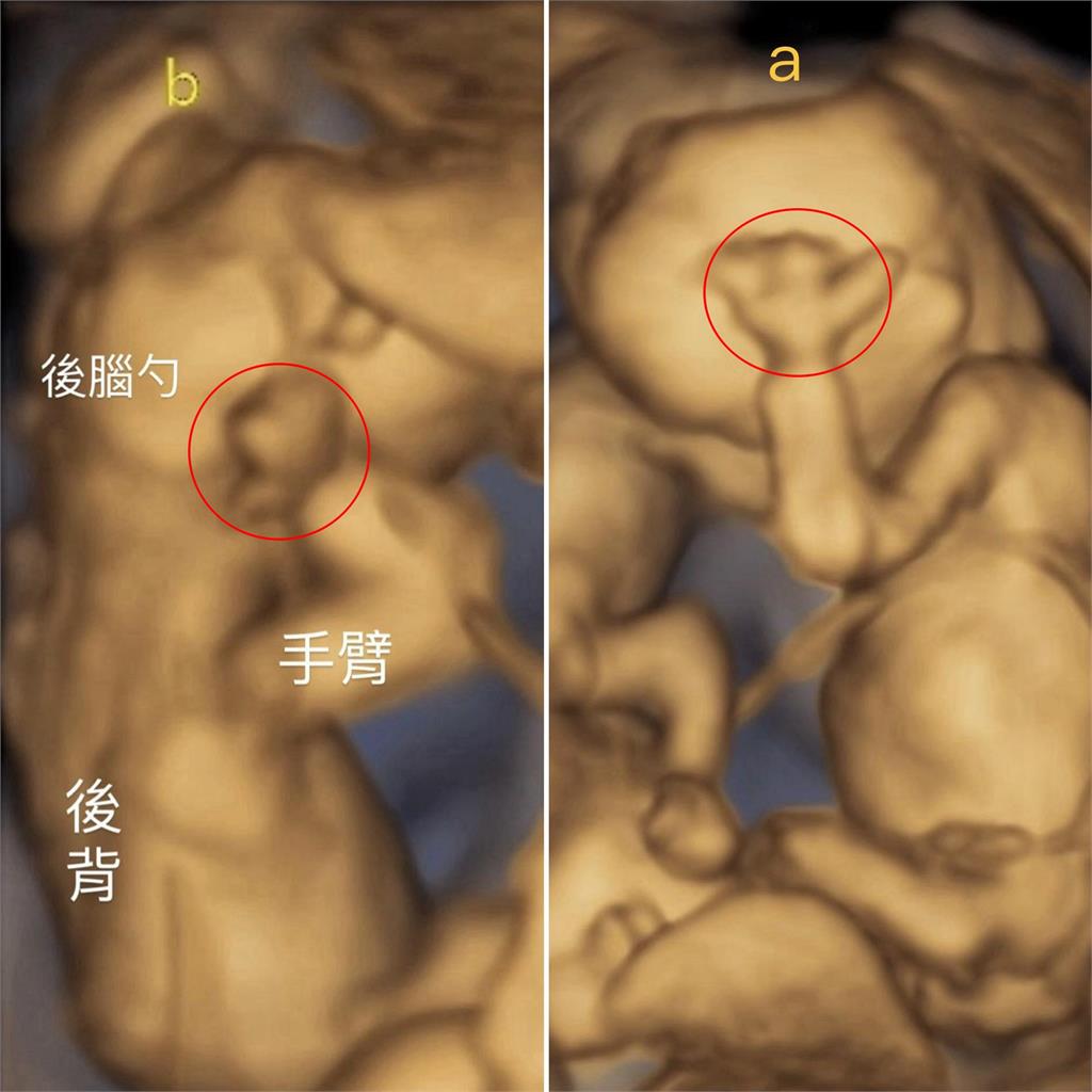 鄭家純懷胎16週爆身材「1變化」!曬超音波「雙寶做1姿勢」:在安慰我