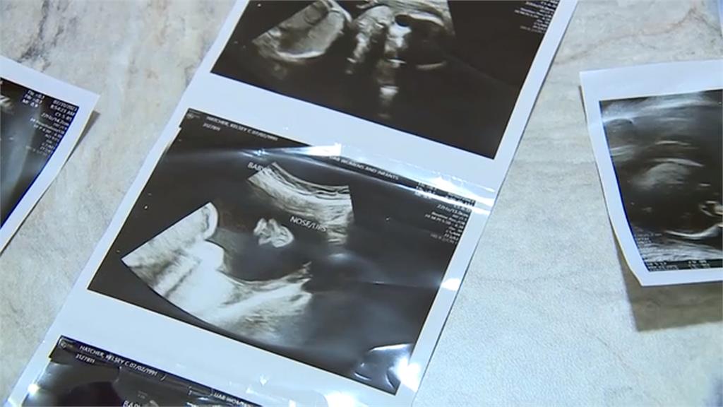 喜迎雙胞胎! 美國孕婦罕見「雙子宮懷孕」
