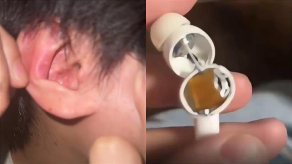 睡到一半耳邊傳巨響!中國「百萬熱銷藍牙耳機」瞬間爆炸 男大生險失聰