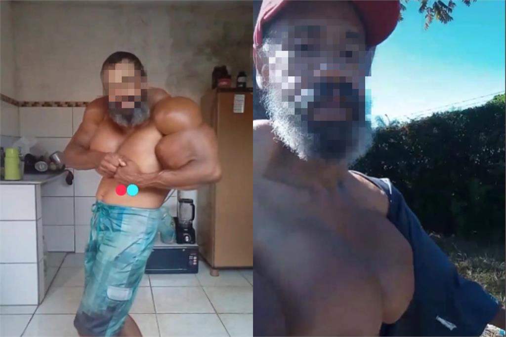 只為大肌肉!巴西男網紅「狂打合成醇」突暴斃170萬粉絲全嚇傻