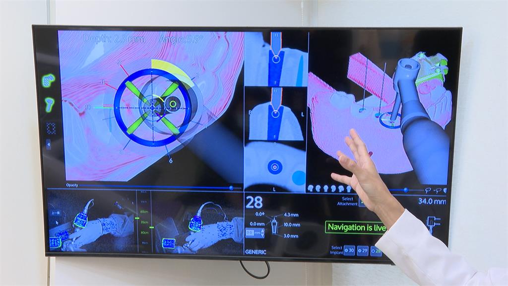 精準植牙時代來臨 「ALL-on-4」植牙十年維持率逾9成