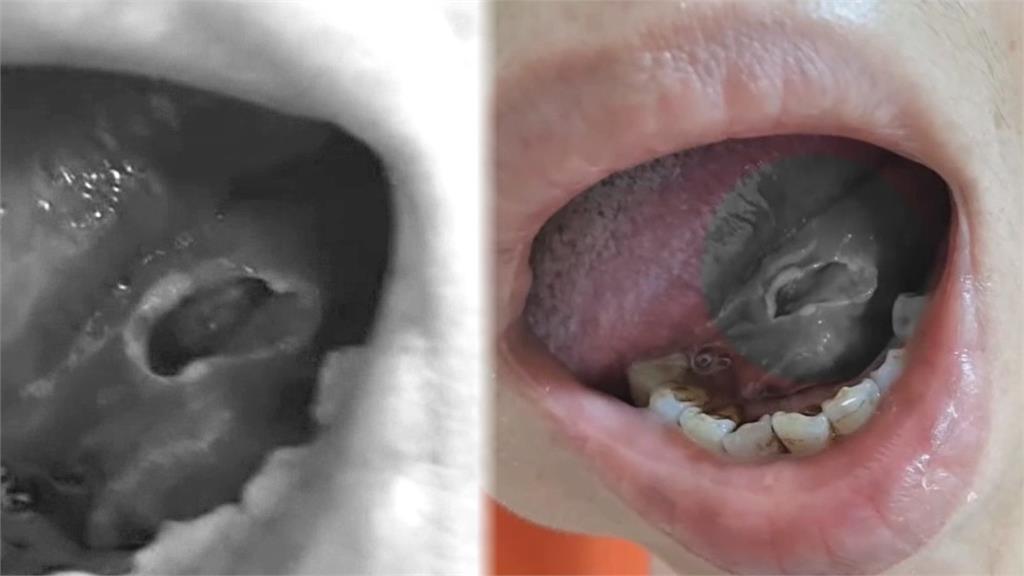 牙醫手滑「鑽出驚天大洞」竟辯破皮而已!網一看驚呆崩喊:毛骨悚然