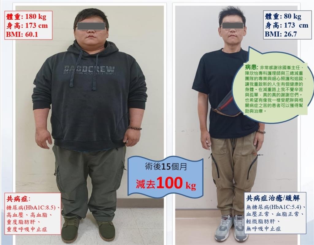 15個月減掉100公斤! 2嚴重肥胖個案靠手術+藥物成功瘦身