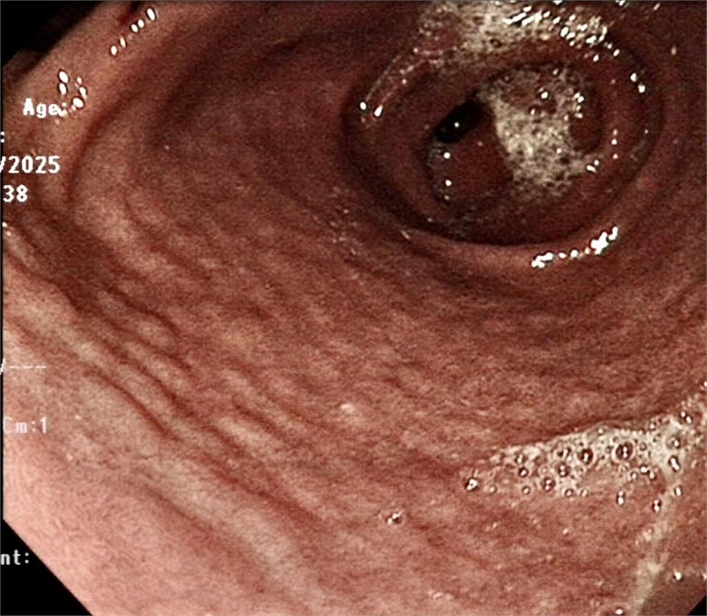 他突吐血照胃鏡驚見「一顆顆鵝卵石」！竟是感染「一級致癌物」最嚴重下場曝光