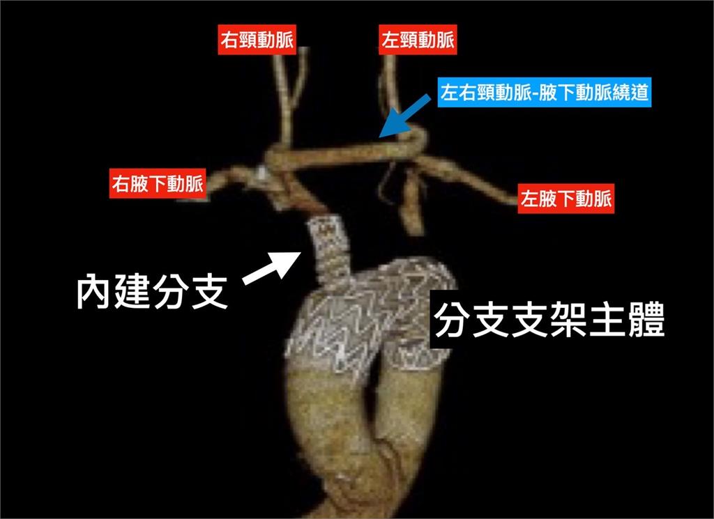 不開胸、心臟不停跳完成手術治療 林口長庚引領微創主動脈分支支架手術新紀元