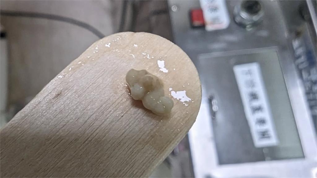  50%台人都中招！一張嘴「小米粒」超臭...醫示警「1壞習慣」養結石