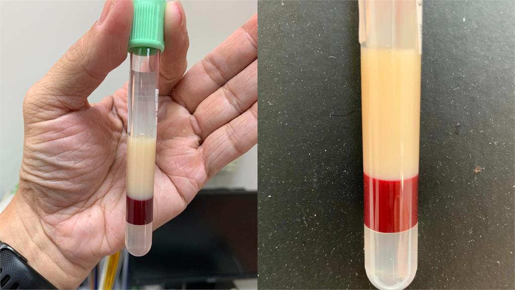 抽血半管全是油！醫曝「油血分離」1圖勸世網驚：跟冰箱那罐豬油一樣