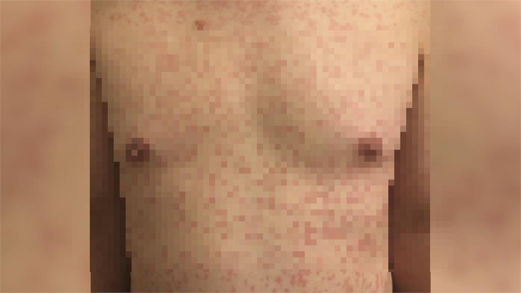 「延遲性過敏」！　50歲男接種莫德納　3天後紅疹