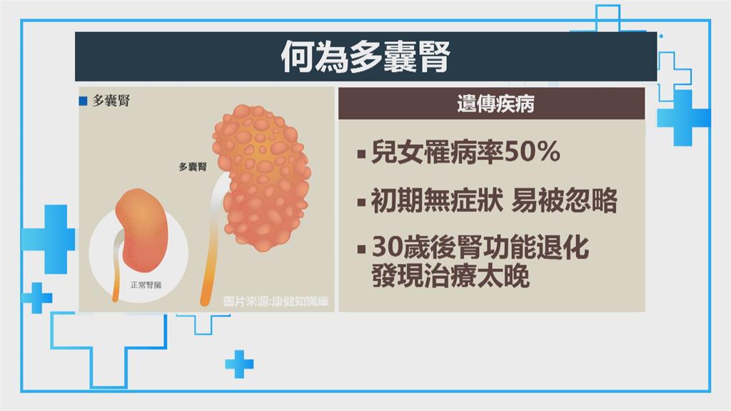 多囊腎治療露曙光　口服新藥免於洗腎危機