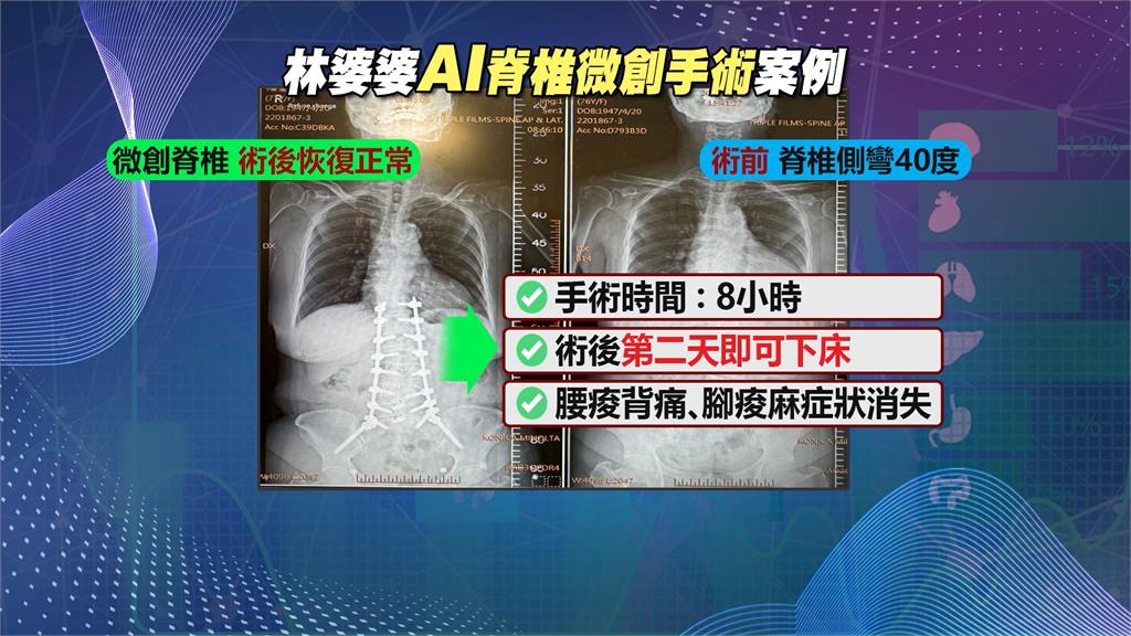 「AI脊椎手術」喬側彎　70歲嬤術後第2天疼痛痊癒