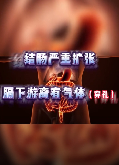 結腸穿孔險喪命！9歲童吃夜市「1食物」緊急進ICU　醫曝關鍵原因