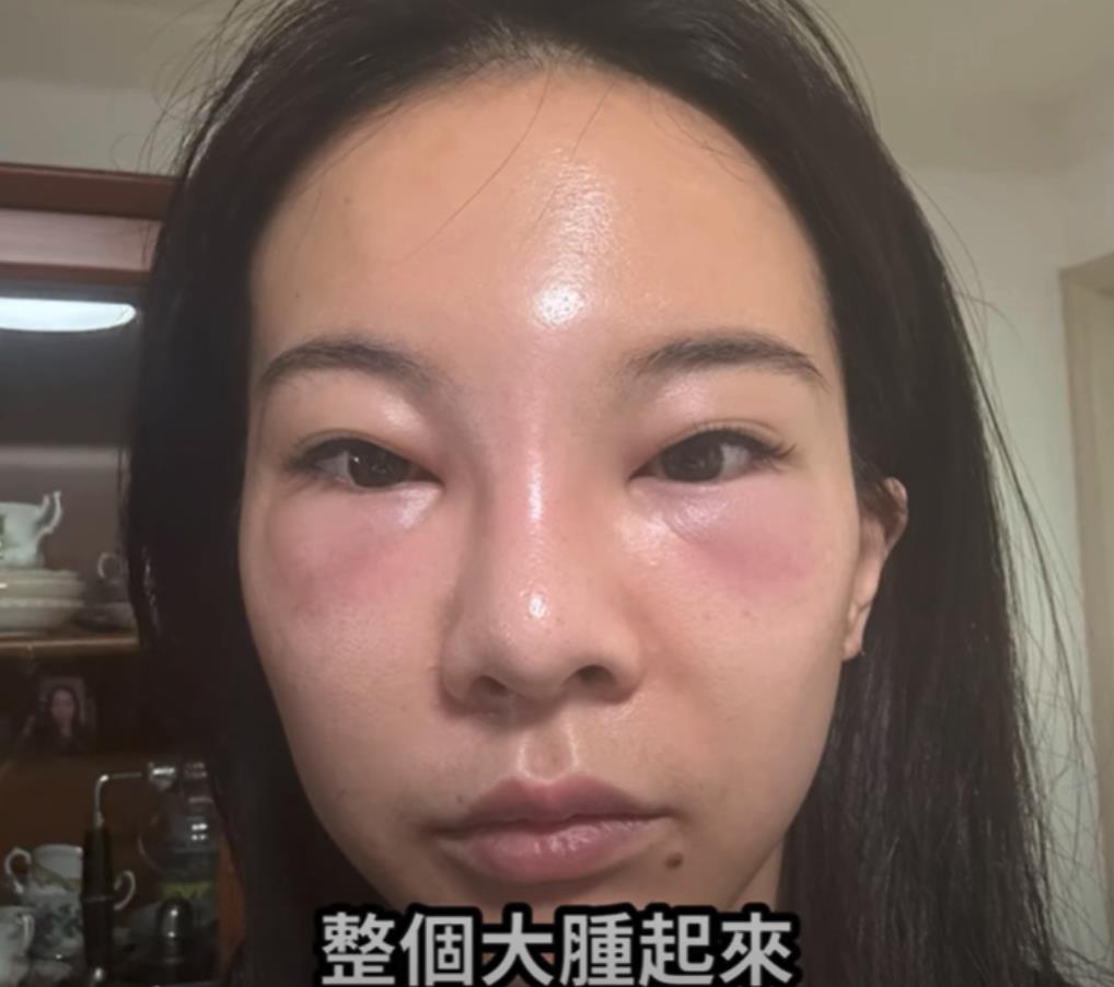 熬過「全臉腫變形」奎丁PO暗黑畫面！網揪1細節喊：根本Karina