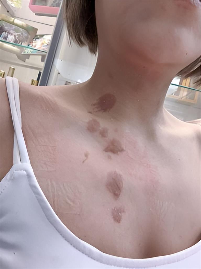 李明珊熱油噴臉「胸口也遭殃」!月初才 「把手當雞塊炸」…鳳小岳也燙傷