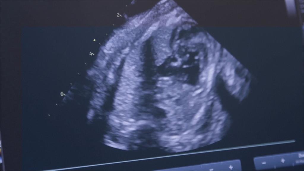拯救早產兒！　科學家打造「人造子宮」延續生機