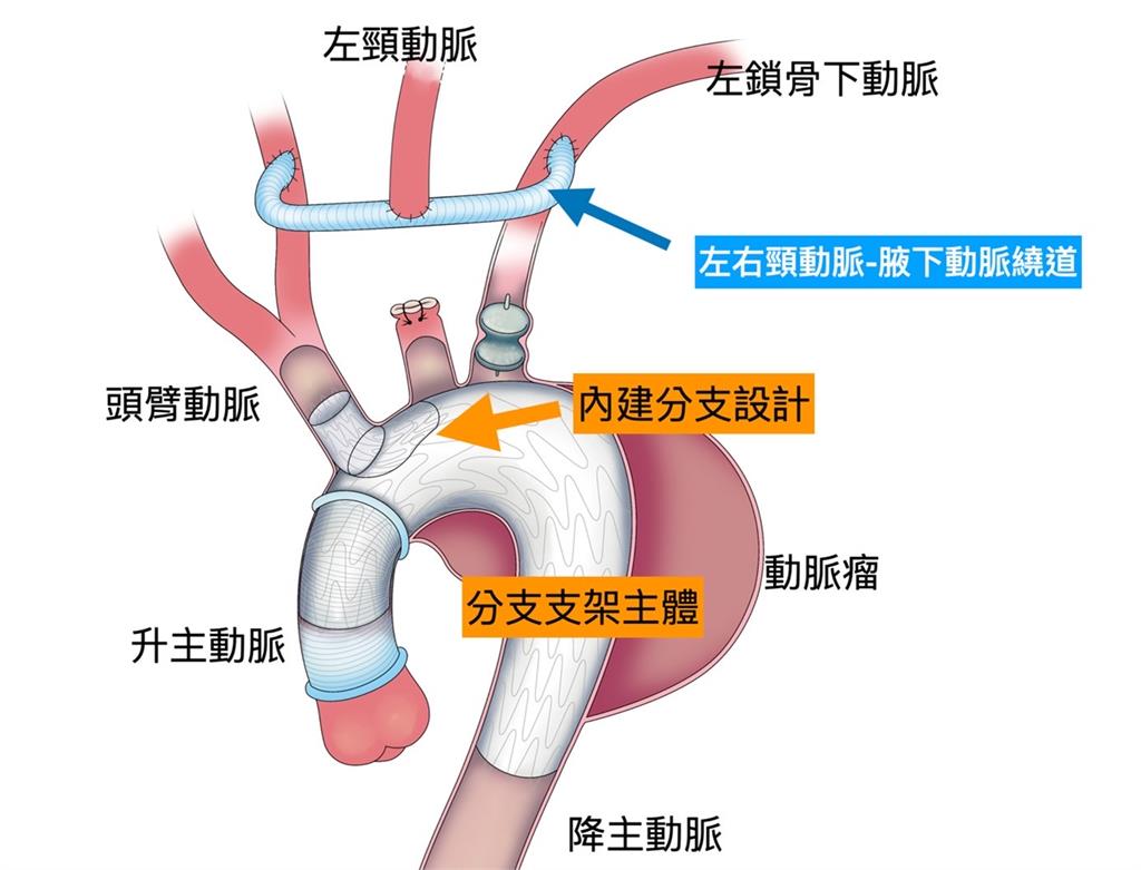 不開胸、心臟不停跳完成手術治療 林口長庚引領微創主動脈分支支架手術新紀元