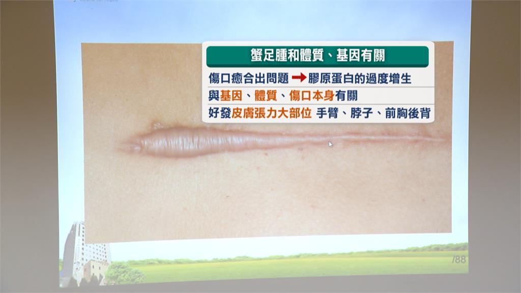 疤痕消不掉、凸起發癢 傷口未正常癒合恐是「蟹足腫」
