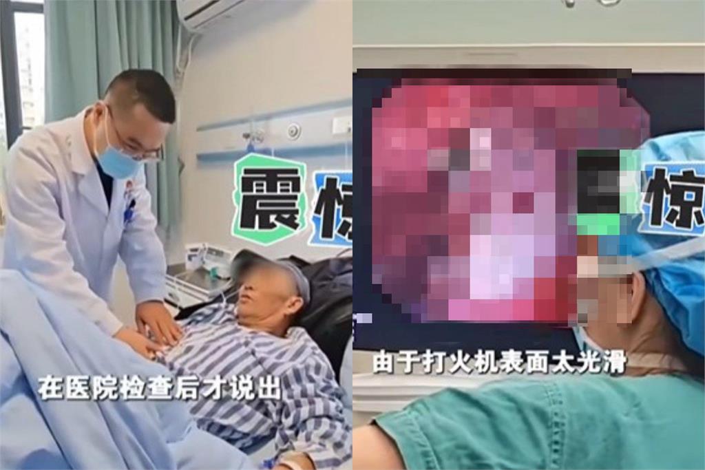 67歲老翁胃裡藏「30年前打火機」肚子爆痛！醫靠「1害羞小物」取出竟還能點火