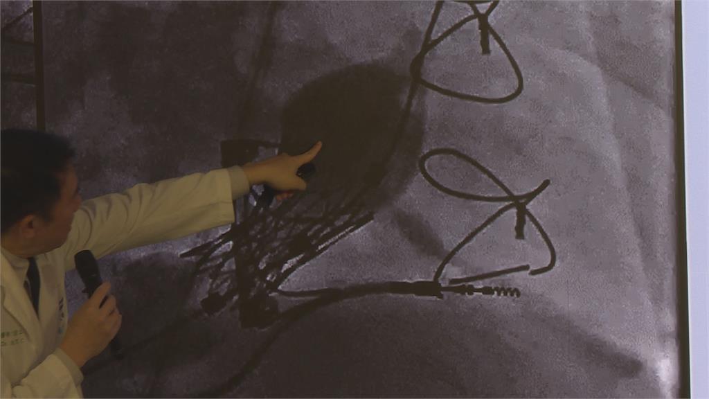 全國最年輕！１２歲心臟病童免動大刀　以「微創心導管技術」重獲新生