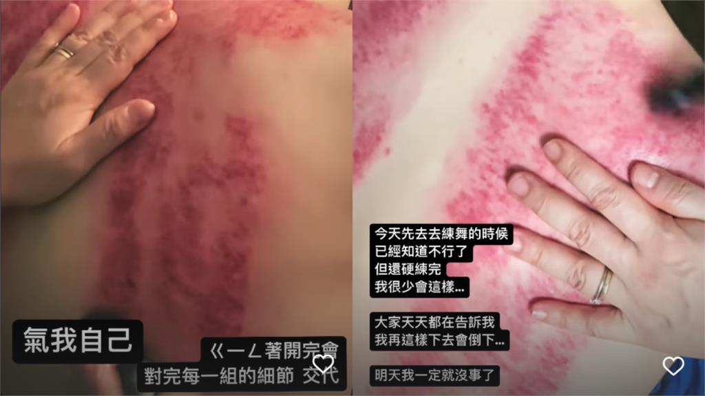 周湯豪攻蛋前驚曬「血紅翅膀」撕背痛炸!認了很氣自己:再這樣會倒下
