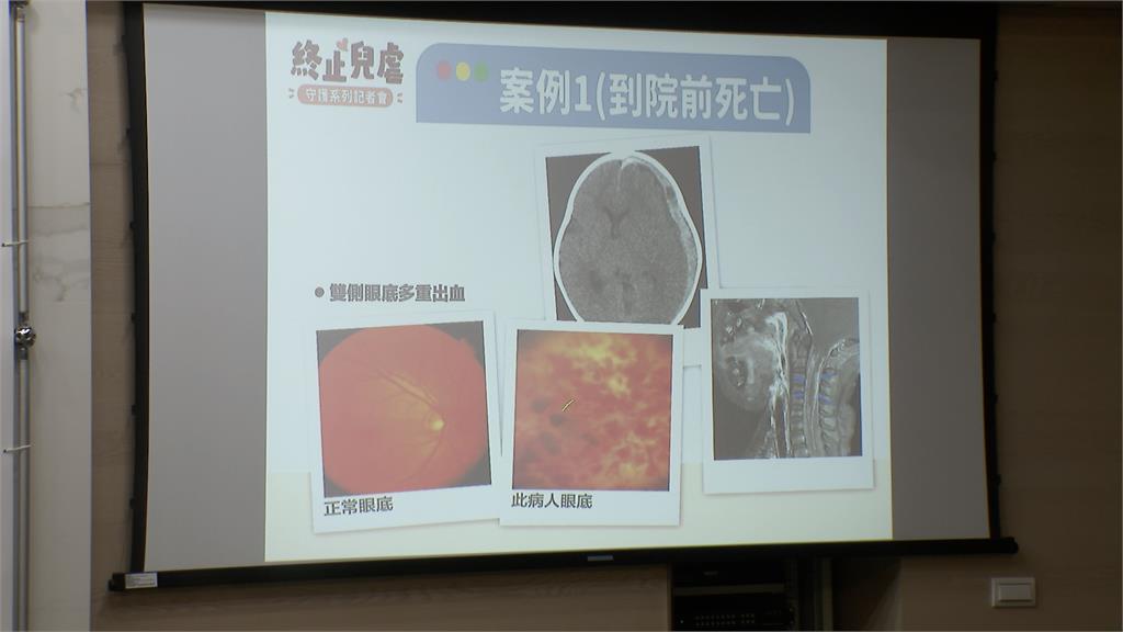 「受虐性腦傷」致死率高! 衛福部盼終止兒虐