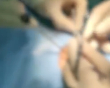 眼睛痛醫生檢查竟「挖出2.5cm原子筆頭」！他憶：27年前被同學戳過…