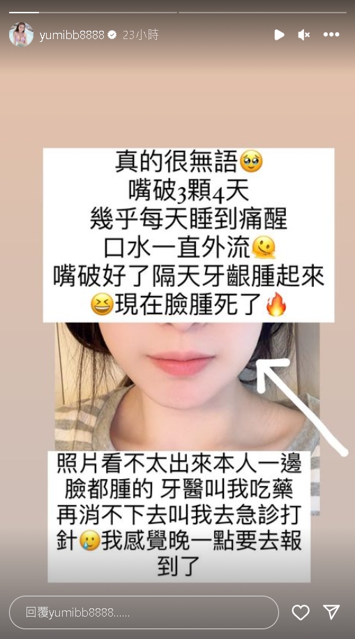 性感辣模深夜掛急診!Yumi.k哀怨喊「口水一直外流」半邊腫臉照曝光