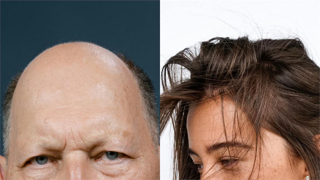 現代人喝「2飲品」攝取過量加速掉髮…專家列「3大重點」:有助毛囊代謝!