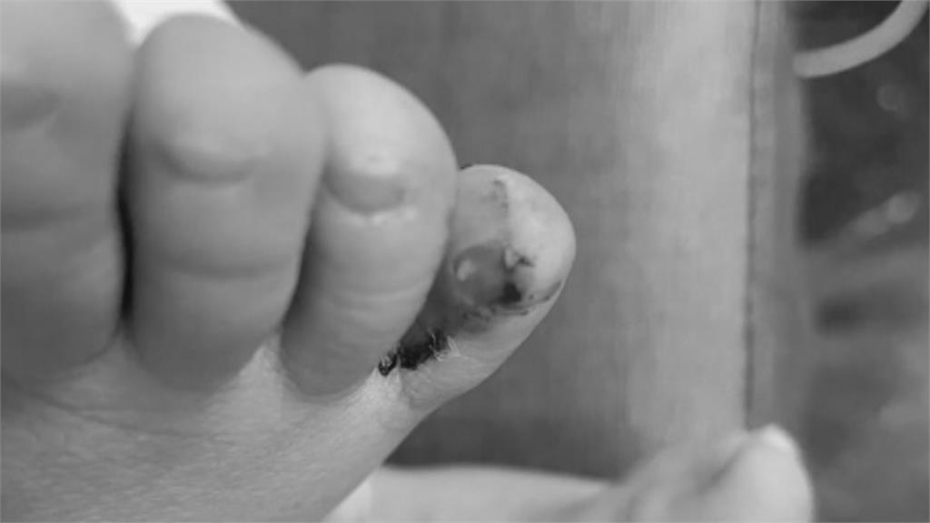 2歲童上學竟「傷痕累累」 家長怒控班導不知情